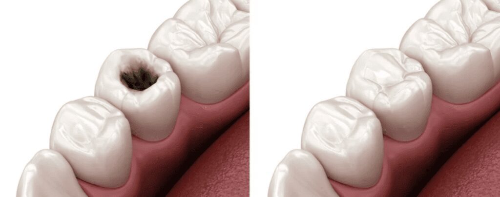 Side by side comparison of tooth with a cavity-left and one with a dental filling-right preventative dentistry dentist in Yardley Pennsylvania