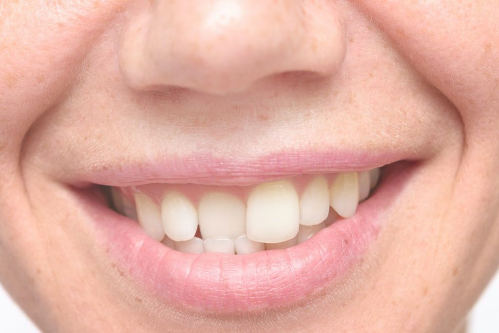 close up shot of crooked teeth cosmetic dentistry dentist in Yardley Pennsylvania