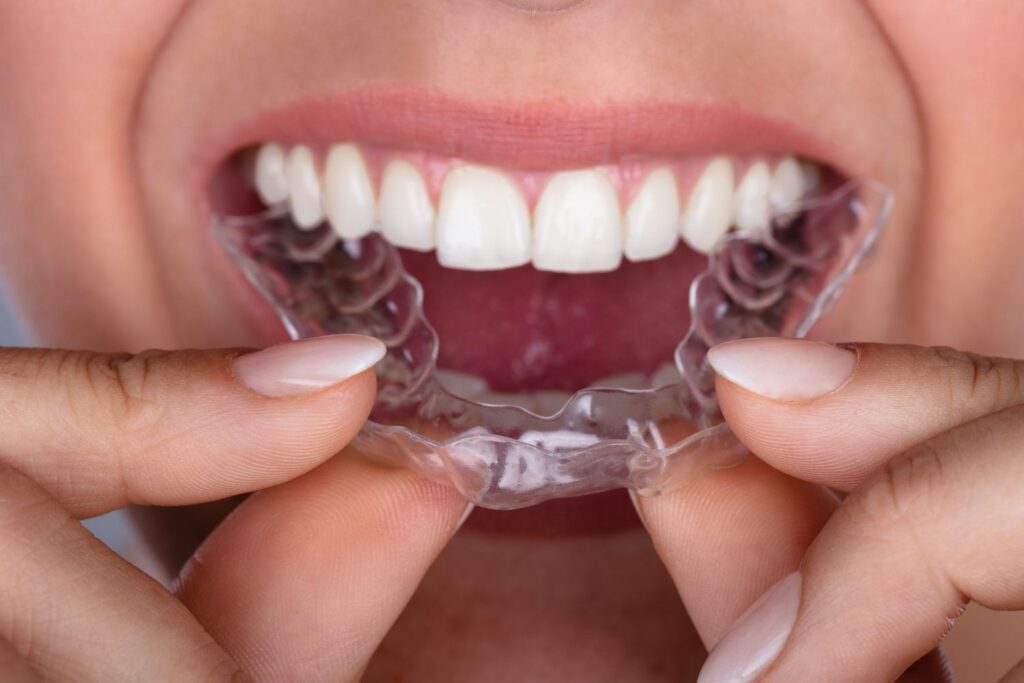 Why Choose Invisalign?