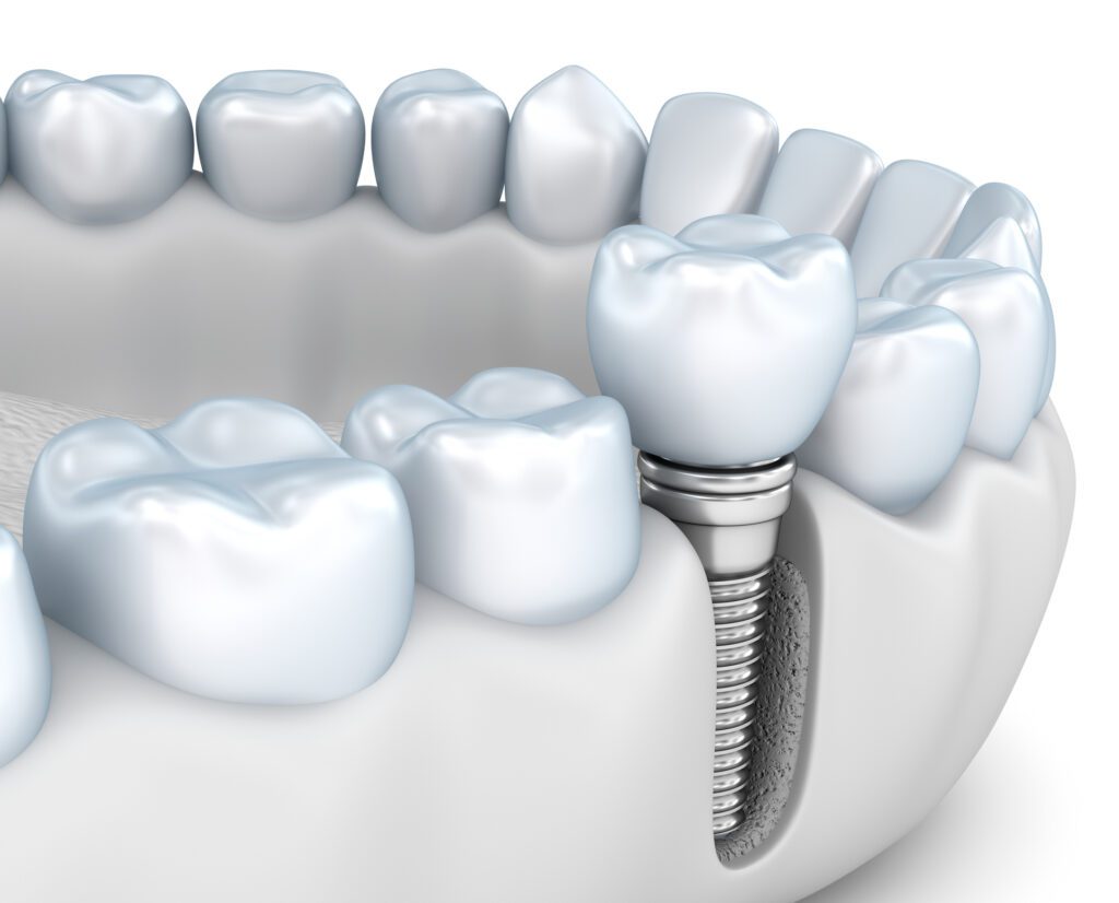 DENTAL IMPLANTS in YARDLEY, PA, are a great restorative option for missing teeth